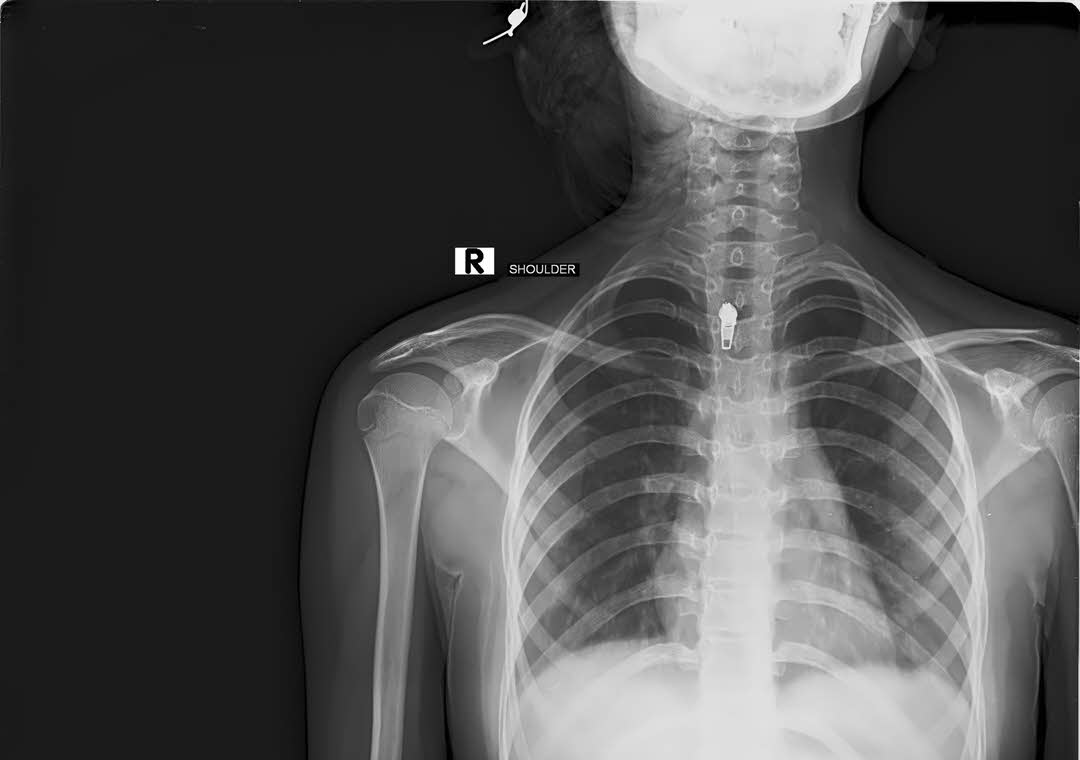 Foreign Object - Medical Malpractice Vermont